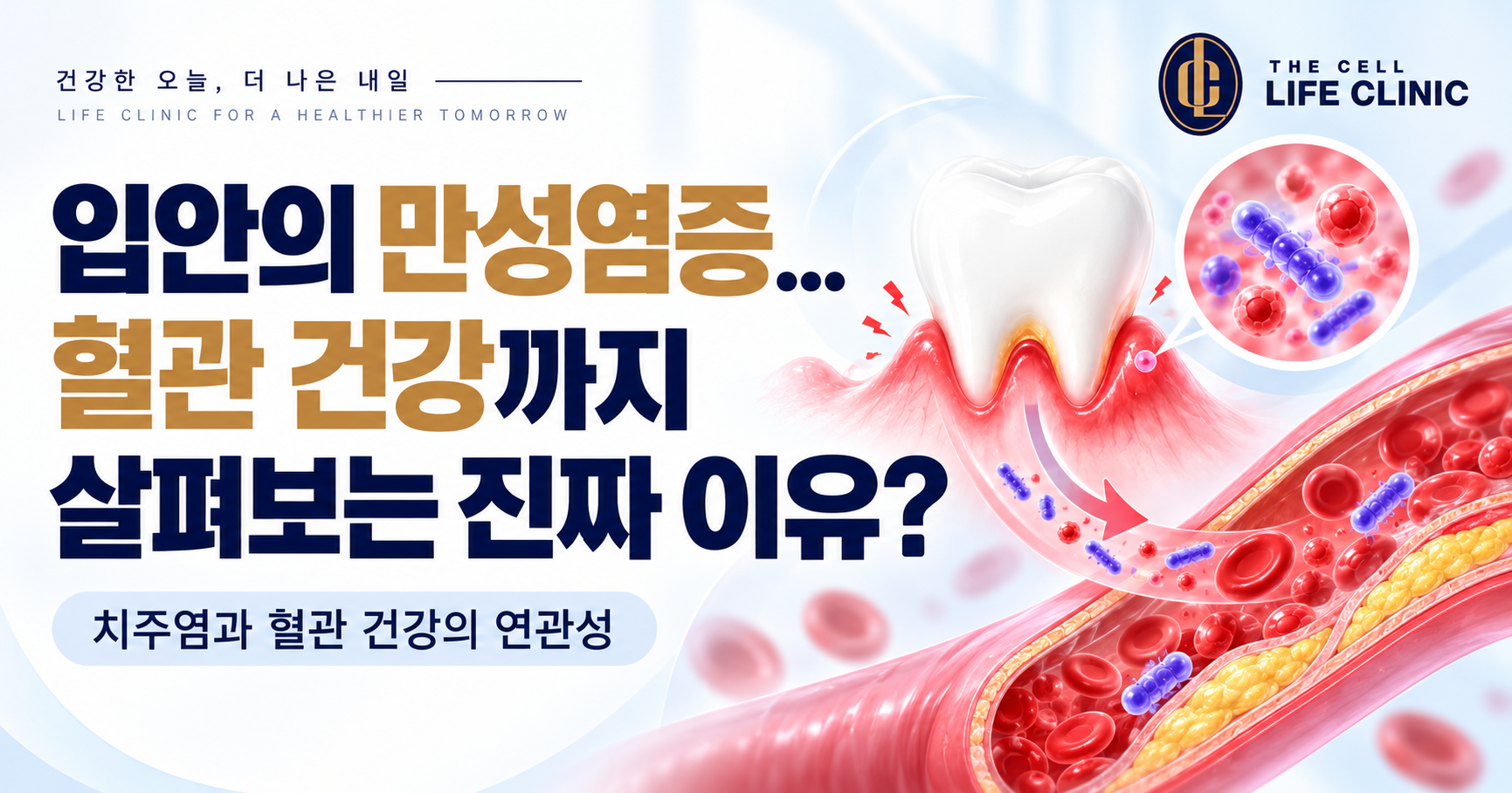 양치할 때마다 잇몸에서 피가 난다면? 치주염과 동맥경화가 함께 언급되는 이유 | 서울 강남 양재역