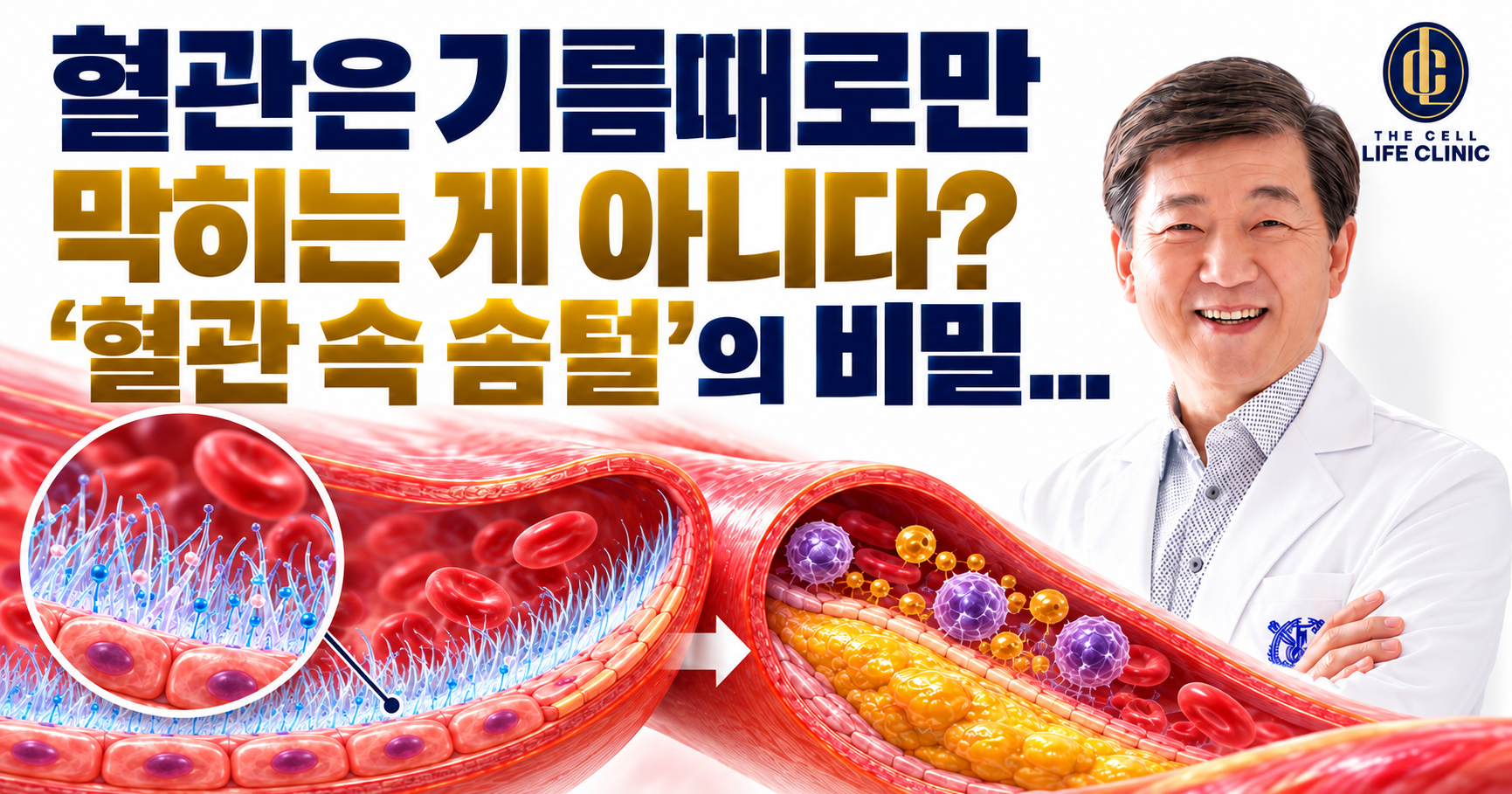 동맥경화 원인, 기름때만의 문제일까? 혈관 속 솜털 글리코칼릭스 | 강남 양재역 라이프의원