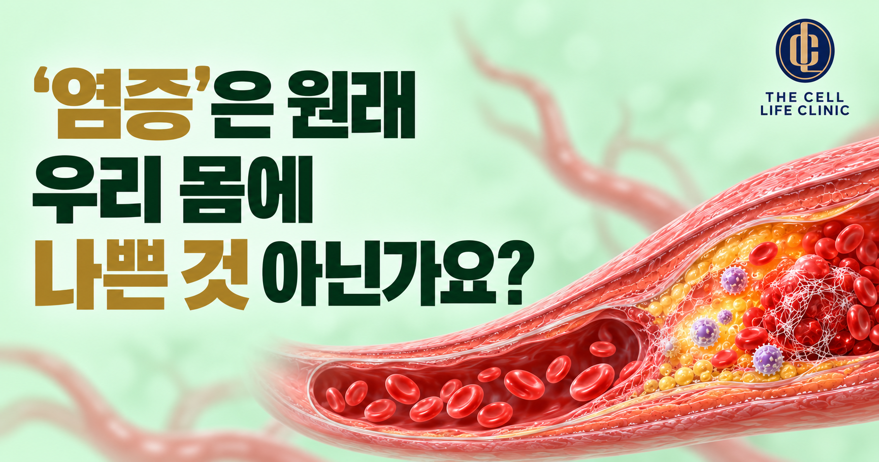 만성염증이 동맥경화를 키울까요? 암·치매까지 연결되는 ‘염증 스위치’ 관리법